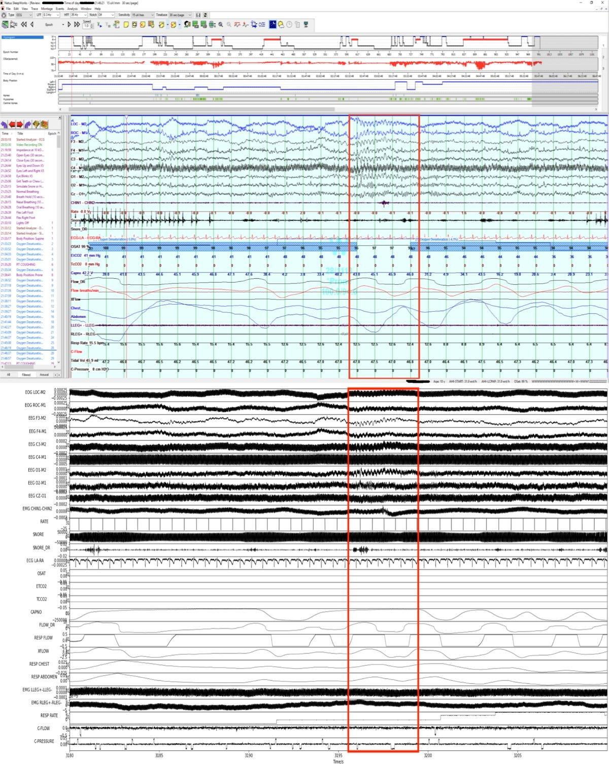 A polysomnography (PSG) readout of the type used to screen for obstructive sleep apnea and other sleep-disordered breathing. BCBAs cannot order or interpret PSG studies — medical screening by a physician or sleep medicine specialist before initiating behavioral sleep intervention is a clinical and liability imperative.