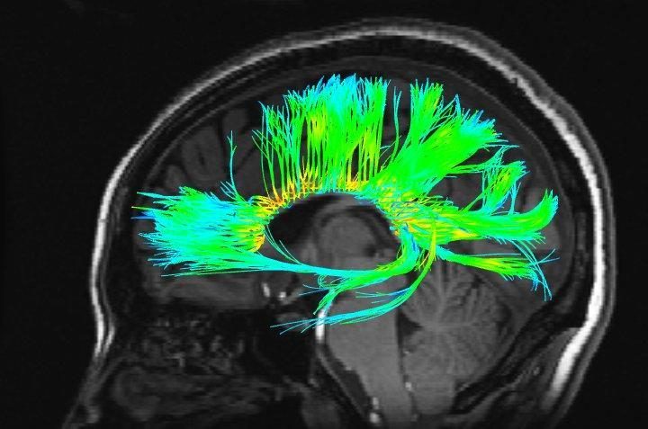 Brain Connectivity Marks Two Biological Autism Subtypes